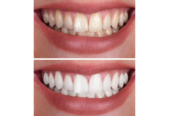 Before & After