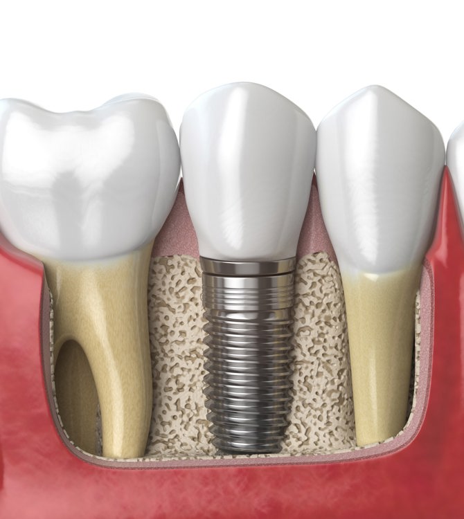 Implant Assessment 