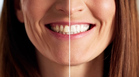 What Foods and Drinks Stain Teeth the Most?
